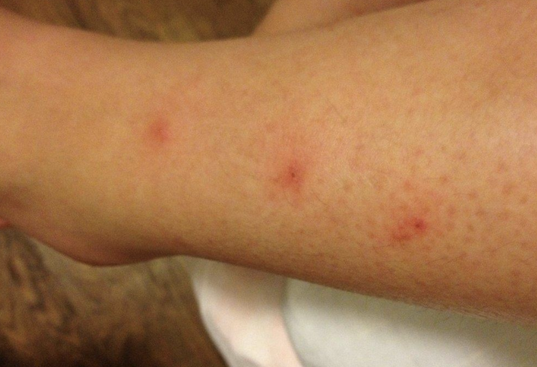 carpet beetle rash