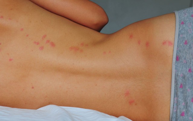 How Do You Know if You Have Bed Bugs